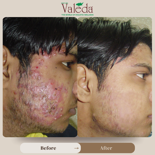 Valeda 15-Day Holistic Acne Treatment Plan – Now at ₹799 (63% Off)