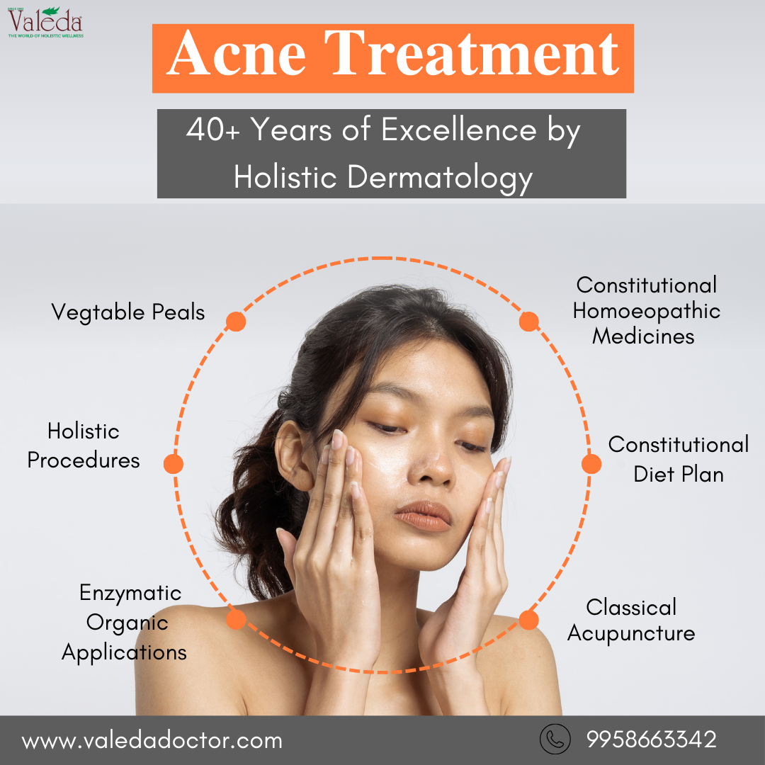 Valeda 15-Day Holistic Acne Treatment Plan – Now at ₹799 (63% Off)